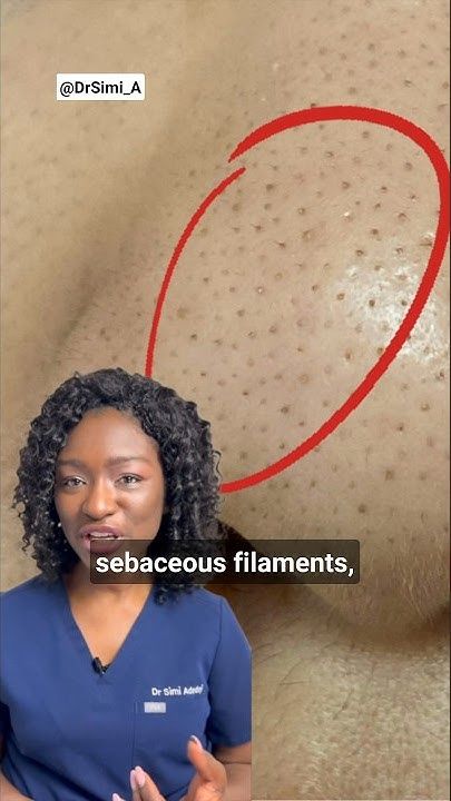 Black Dots on the Nose? Sebaceous Filaments & How To Get Rid Of Them + Products How To Get Rid Of Subatious Filaments, Getting Rid Of Blackheads On Nose, How To Get Rid Of Sebum On Nose, How To Get Rid Of Black Dots On Nose, Nose Bumps Get Rid Of, Strawberry Nose Remedy, How To Get Rid Of Strawberry Nose, Best Way To Get Rid Of Blackheads, How To Get Rid Of Black Heads On Nose