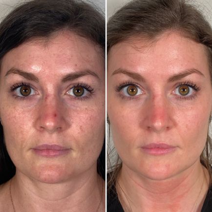 Skin Tightening Before And After, Morpheus 8 Before And After Face, Morpheus8 Before And After, Rf Microneedling Before And After, Morpheus 8 Before And After, Medical Machine, Morpheus 8, Rf Microneedling, Mouth Wrinkles