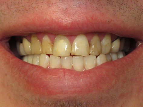 Loose Teeth, Teeth Clenching, Teeth Grinding, Loose Tooth, Dental Veneers, The Dating Divas, Bone Loss, Dark Metal, Home Beauty Tips