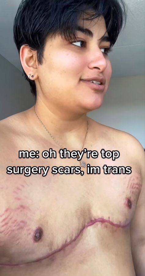 Plus Size Top Surgery, Trans Top Surgery, Trans Top Surgery Tattoos, Top Surgery Art, Top Surgery Ftm, Top Surgery Scars, Top Surgery, Therian Stuff, Trans Art