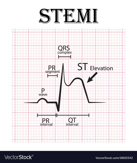 St Elevation Ekg, Stemi Ekg, St Elevation, Cardiology Nursing, Paramedic School, Nursing Information, Nursing Study Guide, Nursing Mnemonics, Nursing Student Tips