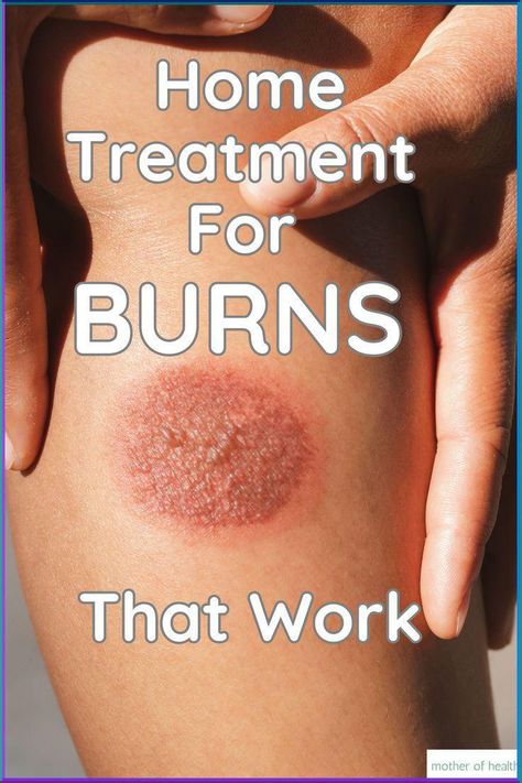 Here are 10 home treatments for burns you can treat at home. Diy Burn Cream, How To Treat A Burn Skin, Skin Burn Remedy, Burn Wound Care, Remedies For Burns, Home Remedies For Burns, Burn Cream, Burn Remedy, How To Heal Burns