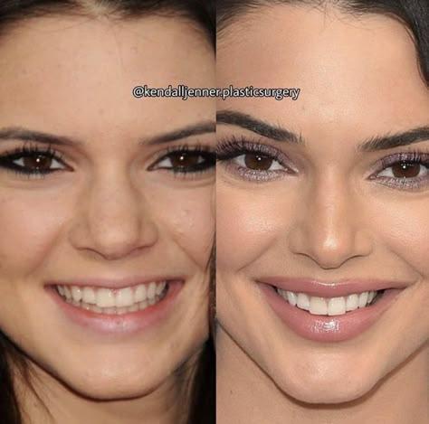 Kendall Jenner Plastic Surgeries, Celebrity Plastic Surgery Before After, Alarplasty Before After, Kendall Jenner Teeth, Kendall Jenner Plastic Surgery, Teeth Transformation, Teeth Goals, Teeth After Braces, Celebrity Teeth