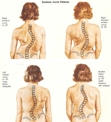 Mild Scoliosis Hypermobility Exercises, Neuroplasticity Exercises, Piriformis Stretch, Spinal Decompression, Cervical Traction, Lower Back Pain Exercises, Physical Therapy Exercises, Heath And Fitness, Back Pain Exercises