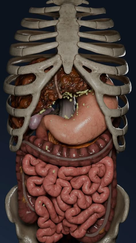 Ascites is a common and challenging complication of liver cirrhosis, where fluid accumulates in the abdominal cavity due to the liver's impaired function.   But what exactly causes this buildup of fluid? When the liver’s ability to regulate blood flow is compromised, it leads to high blood pressure in the portal vein and low albumin levels, which contributes to the fluid leakage into the abdominal space.   With VOKA Anatomy Pro’s hyperrealistic 3D models, students and healthcare professionals can visualize how ascites develops within the body.    #LiverHealth #Ascites #Cirrhosis #LiverDisease #Gastroenterology #3DAnatomy #VOKAAnatomyPro #HealthEducation #MedicalStudents #HumanBody #Anatomy #LearnAnatomy #LiverFacts Function Of Liver, Abdominal Cavity, Liver Anatomy, Inside Human Body, Study Tricks, Anatomy Artwork, Human Anatomy Model, Anatomy Education, Human Body Projects