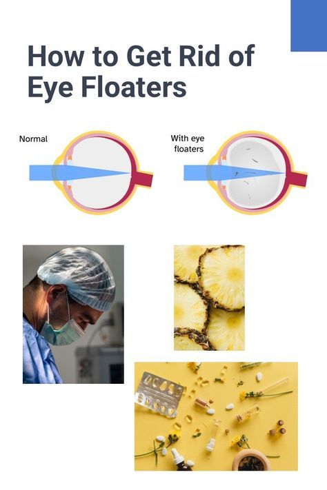 What are the options to get rid of those pesky black spots in your vision? Learn about the surgical treatments and latest studies exploring alternative remedies for eye floaters, including pineapple and nutritional supplements. #EyeFloaters #NewTreatments #NaturalRemedies Castor Oil For Eye Floaters, Eye Floaters Remedies, Stye Remedy, Eye Floaters Causes, Eye Health Tips, Eye Stye Remedies, Eye Health Remedies, Eye Floaters, Health Women