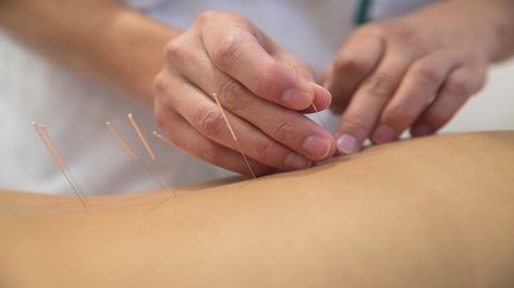 Acupuncture Benefits, Acupuncture Clinic, Back Pain Relief, Sciatica, Acupressure, Alternative Medicine, Massage Therapy, Migraine, Acupuncture