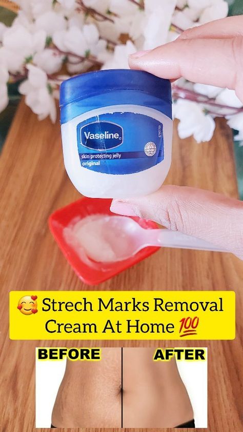 Strech Marks Removal Cream At Home 🏡 . . Ingridents ✅ Vaseline Aloevera gel Vitamin E pill Vitamin A pill Coconut oil . . Follow for… | Instagram Strech Marks Removal, Natural Hair Removal Remedies, Coconut Oil Mask, Strech Marks, Marks Cream, Hairstyles Pigtails, Braids Volleyball, Stretch Mark Removal, Stretch Mark Cream