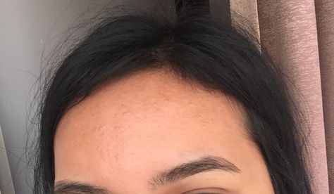 What are these itchy acne-like bumps on my forehead? How can i get rid of them? [Routine help] Round Forehead, Flat Forehead, Small Forehead, Fungal Acne, Classy Photography, Small Flat, How Do I Get, I Wish I Had, Body Goals