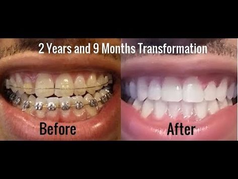 Teeth After Braces Before After, Gap Teeth Braces Before And After, Crossbite Teeth, Before And After Braces Pictures, Underbite Before And After, Braces On Top Teeth Only, Braces Top Teeth Only, Perfect Teeth Braces, Before And After Braces