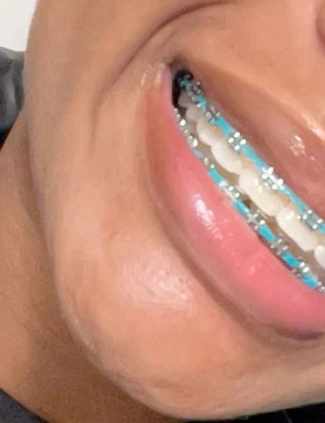 Love these teal braces! So stylish and the perfect pop of color. Definitely getting another pair. 💙 #tealbraces #stylishbraces #coloredbraces #dentalbraces #braceface #orthodontics #smile Light Blue Power Chain Braces, Black Powerchain Braces Colors, First Time Braces Colors, Teal Braces Aesthetic, Bright Blue Braces, Purple And Blue Braces, Braces Aesthetic Pictures, Braces With Power Chains, Braces Light Blue