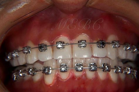 Damon Braces smile Arc Protection Braces Colours, Damon Braces, Braces Smile, Types Of Braces, Adult Braces, Braces Colors, 2024 Goals, Orthodontics Braces, Bright Smile