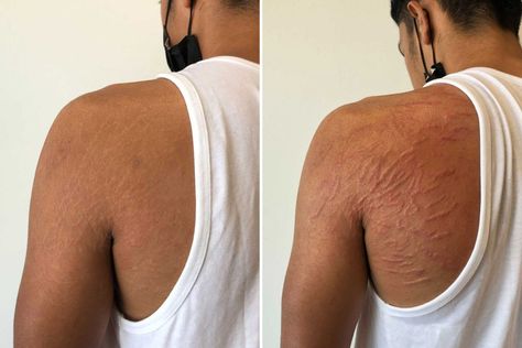 Tattoo artist helps people hide stretch marks and scars with unique no ink method – and goes viral on TikTok Burn Reference, Body Imperfections, Stretch Mark Tattoo, Strech Marks, Book Mood, Forbidden Romance, Marks Cream, Rid Of Blackheads, Scar Cream