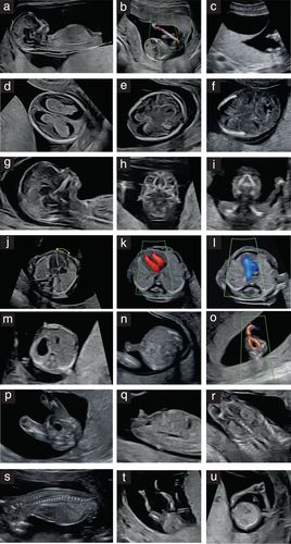 Details are in the caption following the image Nuchal Translucency Ultrasound, Diagnostic Medical Sonography Student, Ultrasound School, Ultrasound Physics, Obstetric Ultrasound, Sonography Student, Ultrasound Sonography, Medical Ultrasound, Radiology Student