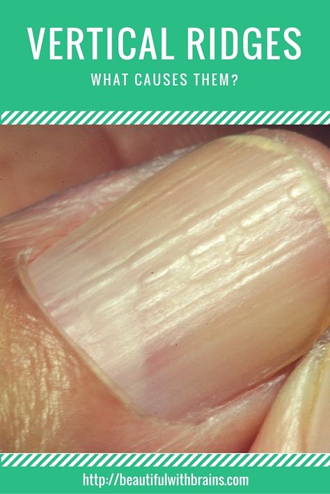 Vertical ridges that extend from the cuticle to the tip of the nail are very common. But are they something you should worry about? What causes them, and can you treat them? Read this to find out. Vertical Ridges On Fingernails, Vertical Nail Ridges, Fingernail Ridges, Nail Health Signs, Fingernail Health, Nail Ridges, Split Nails, Lemon Face Mask, Disney Desserts