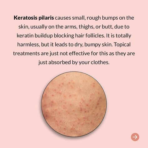 What is KP, and how do we address it? Keratosis pilaris causes small, rough bumps on the skin, usually on the arms, thighs, or butt, due to keratin buildup blocking hair follicles. It is stubborn to manage, but there are actually some fab herbs that really help tackle this 🌱 - Shop via the link in our bio kallistia.com @kallistia How To Get Rid Of Bumps On Private Area, Skin Care For Small Bumps, How To Get Rid Of Keratosis Pilaris, Rough Bumpy Skin, Keratosis Pilaris, Bumpy Skin, Hair Follicle, Keratin, Herbs