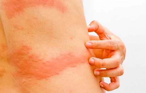 Consider this scenario: You just got back from an adventure vacation and are... Rash On Buttocks, Rash On Stomach, Heat Rash Remedy, Home Remedies For Rashes, Rash On Hands, Types Of Skin Rashes, Common Skin Rashes, Itchy Skin Rash, Body Rash