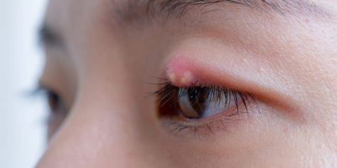 Eyelid Bump: How to Get Rid of Styes and Other Bumps Eye Pimple How To Get Rid, Eye Bumps How To Get Rid, How To Get Rid Of A Stye On Your Eyelid, Bump On Eyelid, White Bump On Eyelid, Get Rid Of Stye, Pimple On Eyelid, Blind Pimple, Pimples Under The Skin