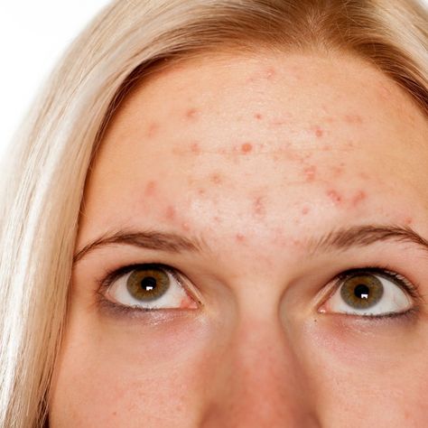 Acne 101: Your Teen's Guide to Clear Skin - Raising Teens Today Teen Acne Skincare Routine, Girl With Acne, Teenage Acne, Forehead Acne, Teen Skincare, Acne Help, Skin Images, Acne Skincare Routine, Severe Acne