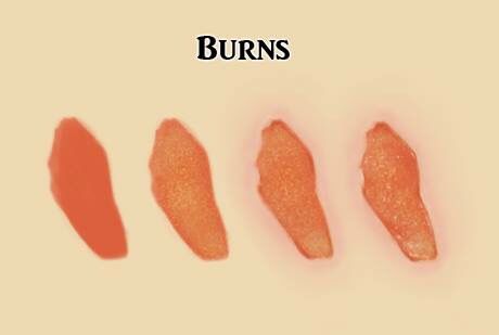 Burns How To Draw Burns On Skin, Burn Injury Drawing, Burned Skin Drawing, Burn Drawing Reference, Draw And Tell Stories, Injury Reference, Body Draw, Skin Drawing, Blood Art