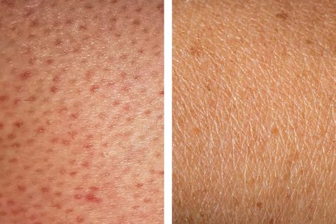 How to Get Rid of Strawberry Legs | Reader's Digest How To Get Rid Of Dots On Legs Skin Care, Flawless Legs Skin, How To Make Legs Look Flawless, Red Spots On Legs, Bumps On Legs, Leg Acne, Exfoliate Legs, Shaving Bumps, Strawberry Seeds