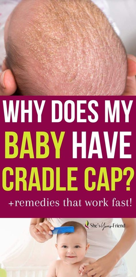 Does your baby have cradle cap? Learn some common causes and what you can do to get rid of it fast! | cradle cap remedies | cradle cap and baby Coconut Oil For Cradle Cap, Essential Oils For Cradle Cap, Cradle Cap Remedies For Adults, Baby Dry Scalp Remedies, How To Get Rid Of Cradle Cap, Baby Dry Scalp, Baby Dandruff, Cradle Cap Remedies, Scaly Scalp