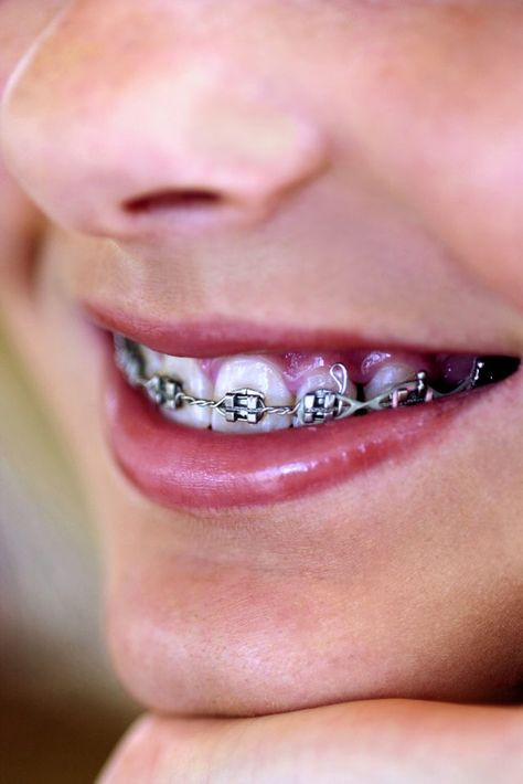 Model fake braces on real ones. Diy Braces, Fake Braces, Kids Braces, Dentist Clinic, Charcoal Teeth Whitening, Braces Colors, Teeth Whitening System, Dental Braces, Orthodontics Braces