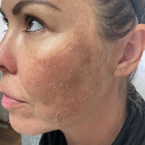 My Skin Looks Worse After Chemical Peel - Is That Normal? Facial Chemical Peel Before And After, Perfect Derma Peel Before And After, Chemical Peel Aesthetic, Chemical Peel Before And After, Botox Business, Chemical Face Peel, Vi Peel, Skincare Marketing, Peeling Face