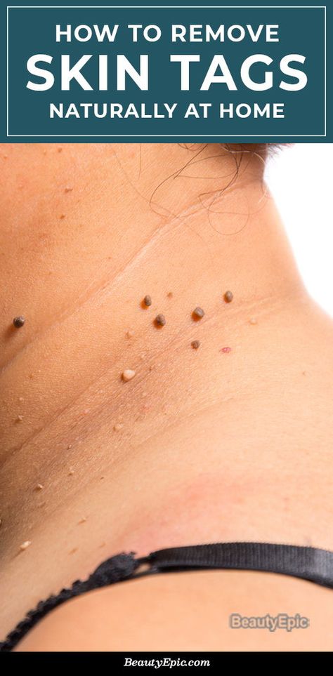 Remove Skin Tags, Remove Skin Tags Naturally, Mole Removal, Home Remedy For Cough, Skin Tags, Cold Sores Remedies, Natural Sleep Remedies, Natural Cold Remedies, Natural Cough Remedies