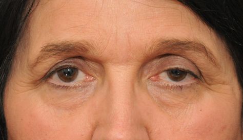 How To Treat Droopy Eyes Naturally and Effectively Natural Remedies For Warts, Lift Droopy Eyelids, Castor Oil Face, Eye Care Routine, Saggy Eyelids, Natural Wart Remedies, Eye Care Tips, Warts Removal, Warts Remedy