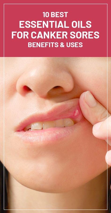 Essential Oils For Mouth Ulcers, Essential Oil For Canker Sore In Mouth, Essential Oils Canker Sore, Canker Sore Remedies, Sore In Mouth Remedies, Gum Sores, Canker Sore Relief, Canker Sore Remedy, Essential Oil Roller Bottle Recipes