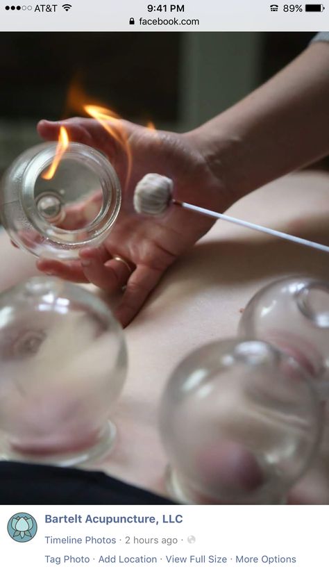 Cupping Fire Cupping, Bed Of Nails, Scrolling Through Pinterest, Cupping Therapy, Tag Photo, Hello Gorgeous, Acupuncture, Graphic Design Art, Nail Design