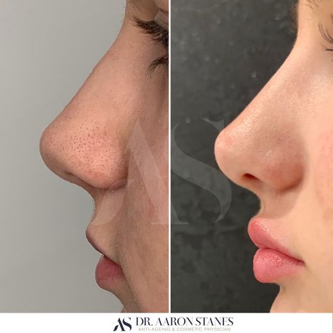 Lip Filler Before And After Side Profile, Small Alar Base Nose, Cute Noses Profile, Side Nose Profile, Lip Fillers Side Profile, Front Nose Profile, How To Fix Your Side Profile, Chin Side Profile, Lip Filler Side Profile