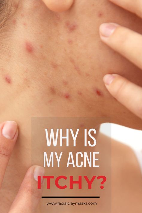 Nothing worse than a bug bite that itches, actually, there's nothing worse than itchy acne. So here's why your acne might be itchy.  Because if you don't know why your acne is itchy, then how can you work on preventing and treating it.  Plus I have some ideas for you on how to treat your acne.   #acne #itchy #itching #itch #pimple #skincare #onface #dry #remedies #causes Blackheads On Face, Cystic Acne Remedies, Acne Tips, Itchy Face, Blind Pimple, Bug Bite, Pimples Under The Skin, Pimples Overnight, Clean Blackheads