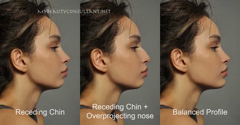 Nose Surgery Rhinoplasty, Chin Filler, Plastic Surgery Fail, Chin Augmentation, Chin Implant, Rhinoplasty Nose Jobs, Face Surgery, Plastic Surgery Gone Wrong, Big Nose Beauty