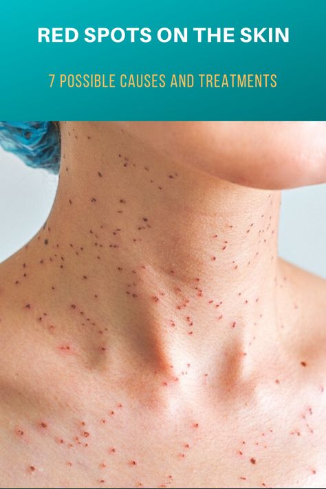 Red Dots On Skin, Red Spots On Skin, Red Spots On Face, Red Skin Spots, Cherry Angioma, What Is Health, Healthy Living Inspiration, Healthy Living Motivation, Health Signs