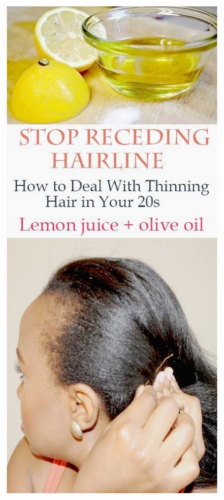 Save Your Hair: Your Hair Will Grow Again, Shinny and Healthy Hairline Remedies, Receding Hairline, Regrow Hair, Lost Hair, Hair Starting, Hair Regrowth, Hair Restoration, Strong Hair, Natural Treatments