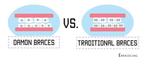 Damon braces vs Traditional braces : Which will be right for you? Damon Braces, Tiana Wedding, Ceramic Braces, Traditional Braces, Braces Colors, Orthodontics Braces, Oral Health, Braces, Health