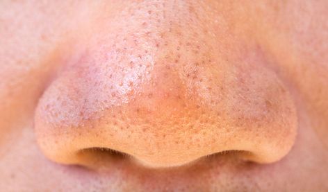 Pimples on the nose are the absolute worst! Read to learn how to get rid of and prevent nose pimples once & for all in 5 simple steps from Tiege Hanley. Big Zits, Nose Pimples, Blind Pimple, Pimples Remedies, Get Rid Of Pimples, Rid Of Pimples, How To Get Rid Of Pimples, How To Remove Pimples, Get Rid Of Acne