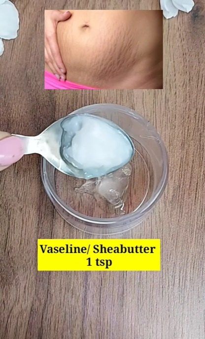 Get Rid of Stretch Marks With This DIY Recipe | Upstyle Strech Marks Removal At Home, How To Get Rid Of Strech Marks On But, How To Get Rid Of Strech Marks On Thighs, Strechmark Remover Skin Care, Strech Marks, Stretch Mark Remedies, Marks Cream, Skincare Secrets, Stretch Mark Removal