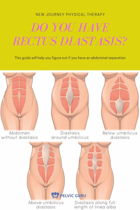 Do I have rectus diastasis? How to know if you have a gap and to start the recovery process Diastasis Recti Looks Like, How To Check For Diastasis Recti, How Do You Know If You Have Diastasis Recti, Severe Diastasis Recti, How To Fix Diastasis Recti Years Later, Correcting Diastasis Recti, Diastis Recti Before And After, How To Avoid Diastasis Recti, Diastasis Recti C Section