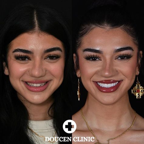 Unlock your perfect smile with veneers! Say goodbye to imperfections and hello to confidence. Transform your smile today. 😁✨ #veneers Dream Teeth, Smiling With Teeth, Perfect Smile, Saying Goodbye, Your Smile, Say Goodbye, Your Perfect, Im Not Perfect, Confidence