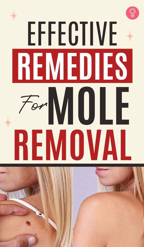 Get Rid Of Moles On Skin, Remove Moles At Home, Skin Mole Removal At Home, Mole Remover Diy, How To Get Rid Of Moles On Your Face, Mole Removal Before And After, How To Remove A Mole On Face, Essential Oils For Moles Removal, How To Get Rid Of A Mole