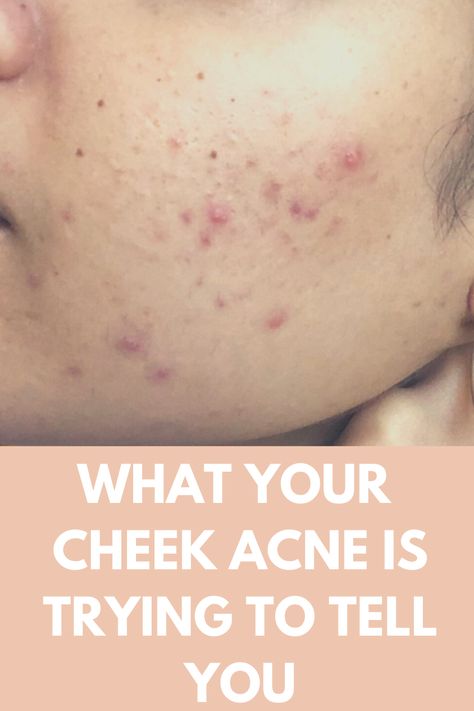 What is your cheek acne or breakout trying to tell you? I've suffered from cheek acne on and off for years so I know how frustrating it can be. When acne pops up in certain areas of the face, it's our bodies way of communicating with us so we have to make sure we're paying attention and connecting the dots. Vist the link below to learn more about what this type of acne means and how to treat it naturally. Why Do I Have Acne On My Cheeks, Acne On Cheeks Meaning, Pimple Area Meaning, How To Clear Cheek Acne, Acne Areas Meaning, What Your Acne Is Telling You, Acne On Cheeks, Pimples On Face Meaning, Cheek Acne Cause