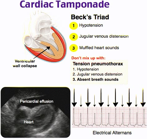 Cardiac Tamponade Cardiac Tamponade, Cardiovascular Nursing, Cardiac Sonography, Emt Study, Cardiology Nursing, Paramedic School, Cardiac Nurse, Nursing School Essential, Nursing Mnemonics