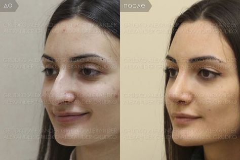 Nose Job Inspiration Natural, Kpop Plastic Surgery, Books Summary, Jaw Reduction Surgery, Nose Surgery Rhinoplasty, V Line Surgery, Nose Fillers, Plastic Surgery Fail, Nose Types