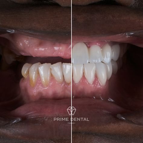 We are beyond excited to share our patients incredible smile transformation! ✨ At Prime Dental, we successfully completed her full mouth rehabilitation, which included 9 implants and 25 zirconium crowns. 🦷💫 We also extracted infected teeth and replaced her missing ones, giving her a fully functional and beautiful smile. Now, she can enjoy the confidence of using her teeth for everything! 😁 Swipe to see the amazing before and after results! Ready for your own smile transformation? Contact ... Dental Before And After, Dental Animation, Smile Transformation, Basic Anatomy, Dental Images, Medical Animation, Basic Anatomy And Physiology, Dental Implant, Anatomy And Physiology