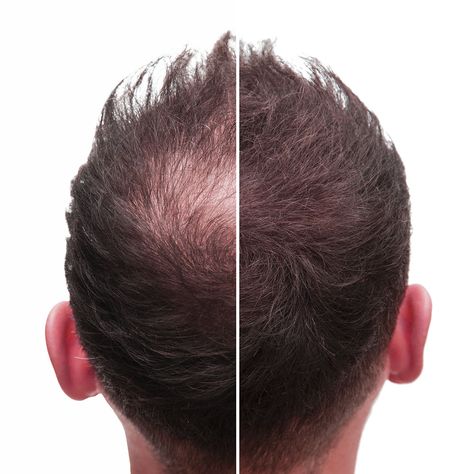 DHT-blocker Shampoo: Is It Proven to Stop Hair Loss? - Roman HealthGuide Treat Thinning Hair, Dunner Wordend Haar, Androgenetic Alopecia, Hair Growth Cycle, Regrow Hair, Hair Control, Grow Hair Faster, Hair Problems, Hair Regrowth