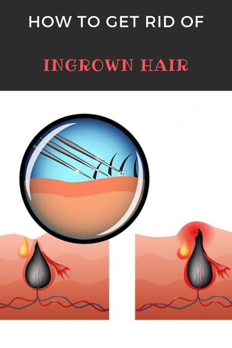 They itch, hurt and look unattractive: ingrown hair. But how can you prevent them and what helps once they are there? And can they really lead to blood poisoning? How To Get Rid Of Ingrown Hairs On Vag, Ingrown Pimple, Ingrowing Hair, Treat Ingrown Hair, Ingrown Hair Remedies, Bump Hairstyles, Chin Hair, Nail Infection, Hair Remedies