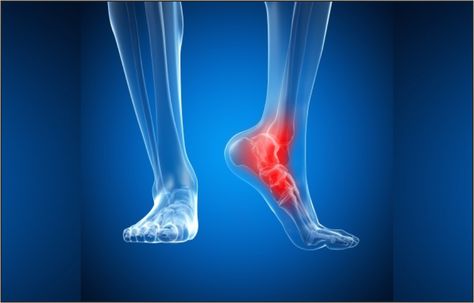 A fractured ankle may range from a simple break in a bone, which cannot stop you from walking to various fractures, which forces your ankle out of position and can need that you don’t put weight on it for a few months. Ankle Break, Fractured Ankle, Ankle Ligaments, Ankle Fracture, Broken Ankle, Bone Fracture, Diagnostic Imaging, Mri Scan, Ways To Sleep